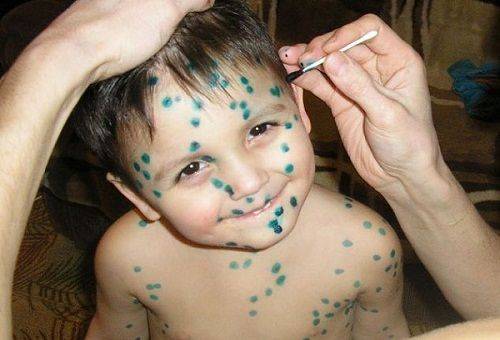 varicela en un niño