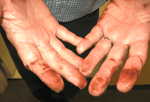 manchas de permanganato de potássio nas mãos