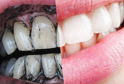 dentes antes e depois do clareamento